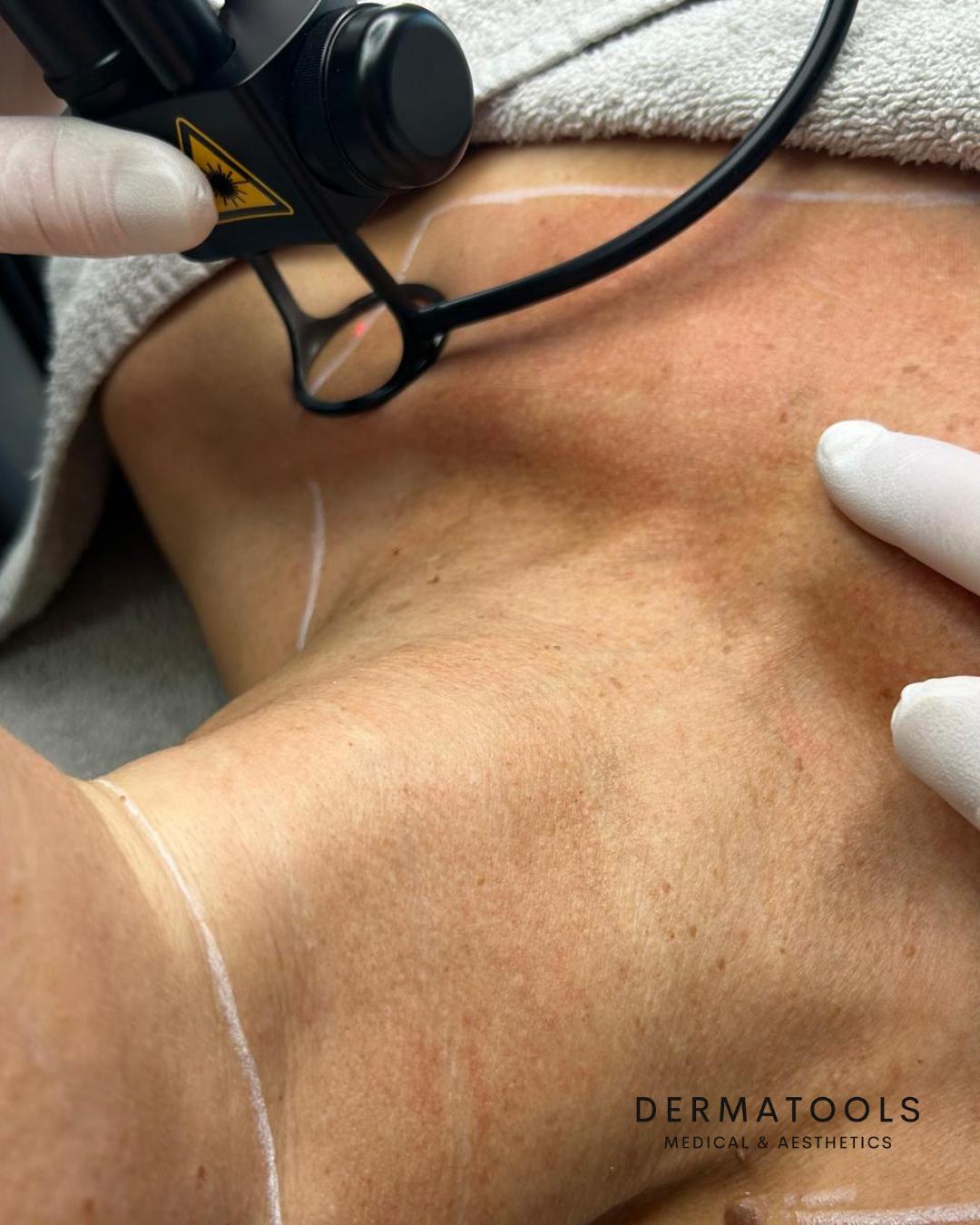 Fractional X Pro co2 Laser