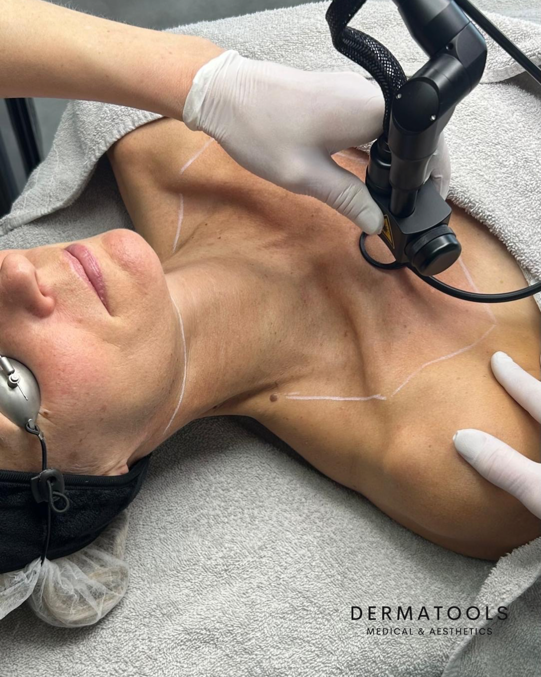 Fractional X Pro co2 Laser