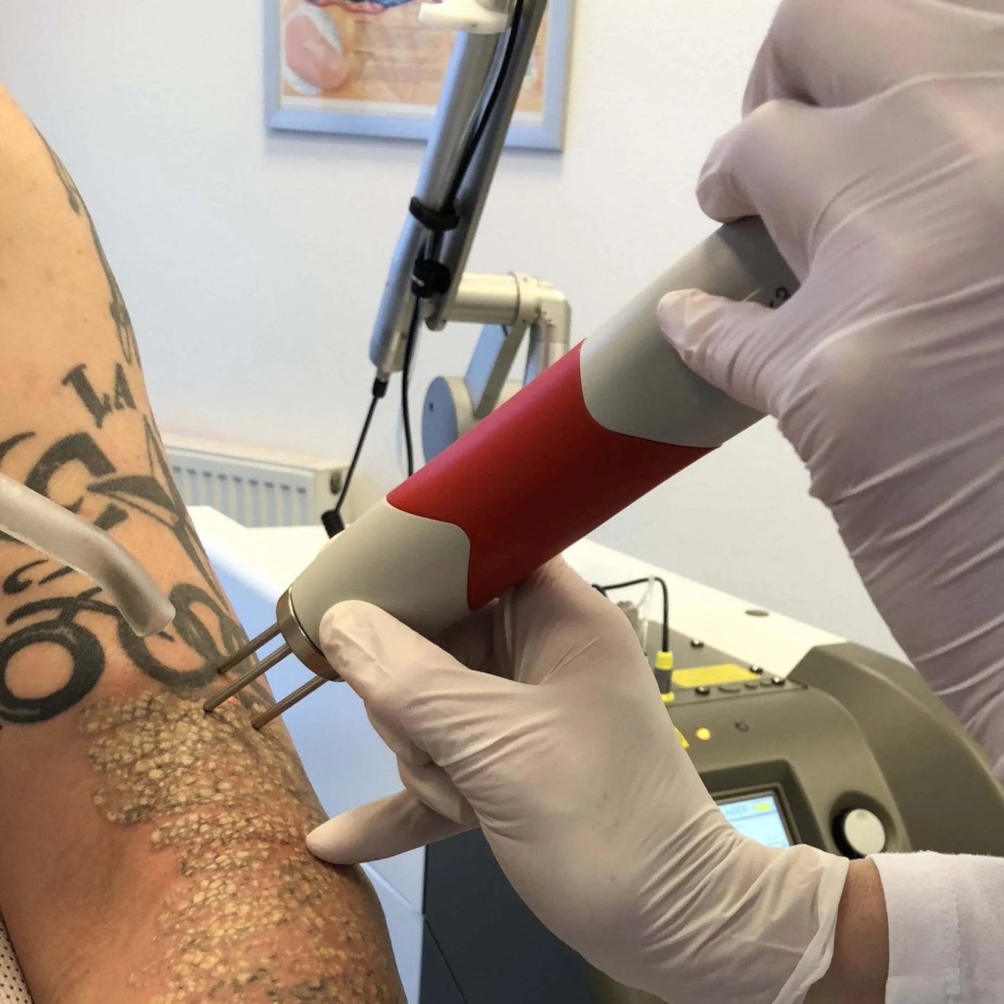 Privé basis cursus Tatoeage verwijderen met Pico laser ( 1 dag )