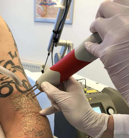 Privé basis cursus Tatoeage verwijderen met Pico laser ( 1 dag )